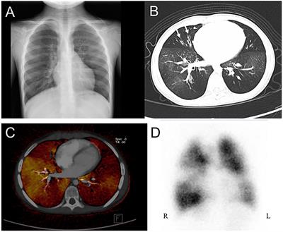 Post-infectious Bronchiolitis Obliterans: HRCT, DECT, Pulmonary Scintigraphy Images, and Clinical Follow-up in Eight Children